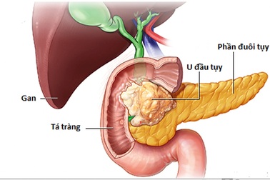 Ung thư tụy: Phát hiện như thế nào?