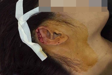 Hải Dương: Cô giáo bị phụ huynh cắn đứt đoạn tai dài 2cm