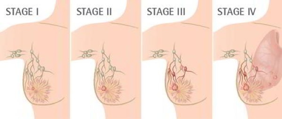 Phối hợp phẫu thuật và xạ trị cho bệnh nhân ung thư biểu mô tuyến vú không xâm lấn - 1 Phối hợp phẫu thuật và xạ trị cho bệnh nhân ung thư biểu mô tuyến vú không xâm lấn - 1