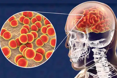 Sau 2 ngày sốt rét run, chàng trai Hà Nội bất ngờ co giật kèm mất ý thức