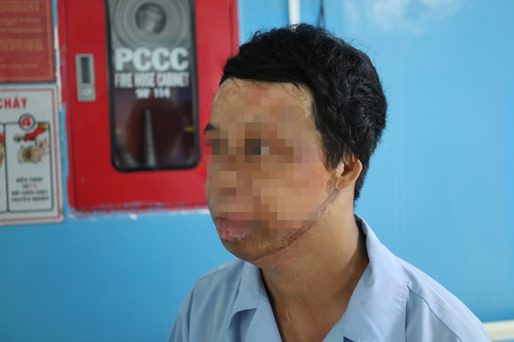Chàng trai hóa “ngọn đuốc sống” vì hút thuốc khi đổ xăng, đi mổ hơn 20 lần - 1 Chàng trai hóa “ngọn đuốc sống” vì hút thuốc khi đổ xăng, đi mổ hơn 20 lần - 1
