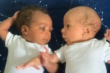 Kỳ lạ cặp sinh đôi một da đen, một da trắng