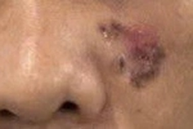 Đi khám nhiều lần ở nước ngoài là nốt ruồi, về nước phát hiện ung thư