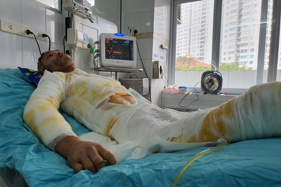 Chàng trẻ nguy kịch sau vụ tai nạn thương tâm mất nửa phần da cơ thể - 4 Chàng trẻ nguy kịch sau vụ tai nạn thương tâm mất nửa phần da cơ thể - 4