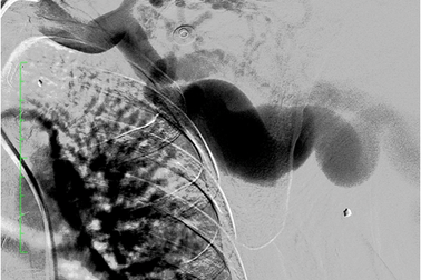 Mảnh đạn nằm trong cơ thể 43 năm xé rách mạch máu