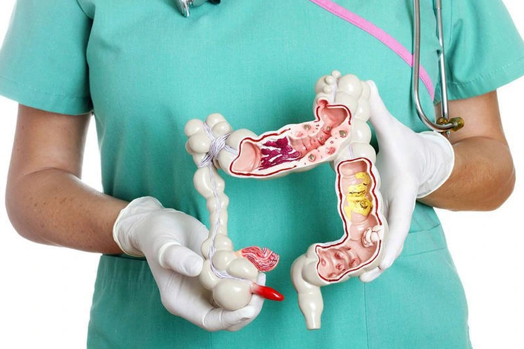Nhập viện vì đi ngoài ra máu, bất ngờ phát hiện polyp khủng - 1 Nhập viện vì đi ngoài ra máu, bất ngờ phát hiện polyp khủng - 1