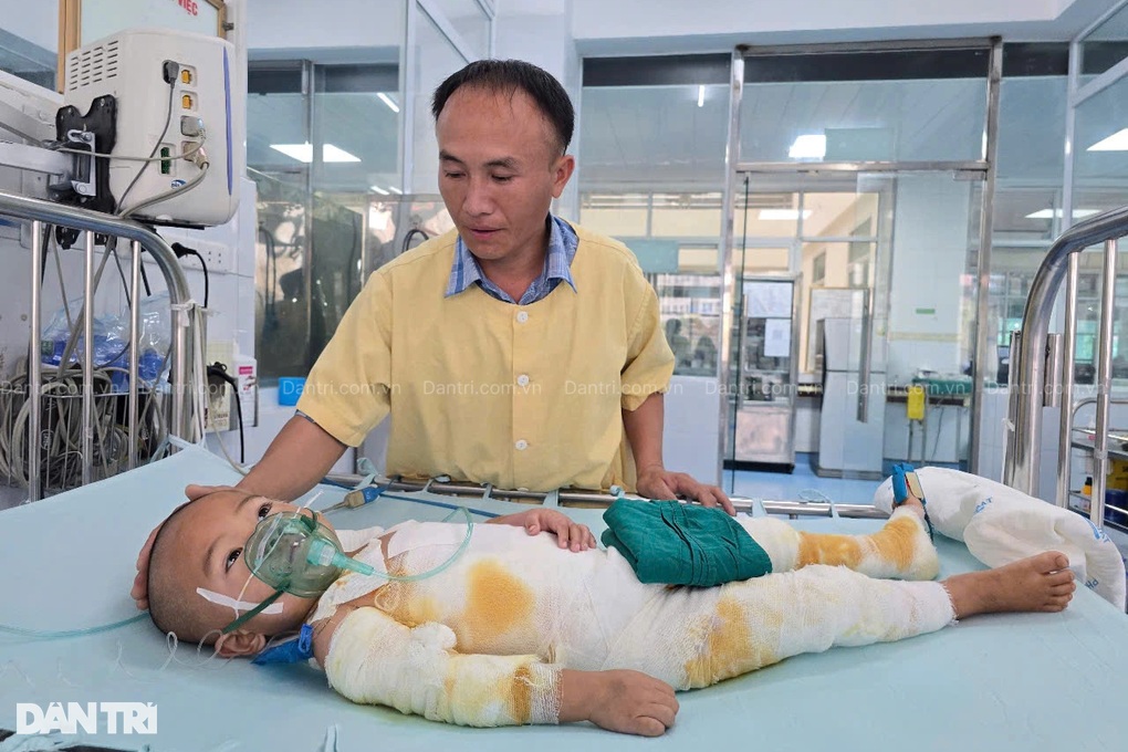 Ngã vào nồi cám lợn nóng, bé 3 tuổi dân tộc Mông bỏng 48% cơ thể - 3 Ngã vào nồi cám lợn nóng, bé 3 tuổi dân tộc Mông bỏng 48% cơ thể - 3