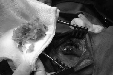 Phẫu thuật gắp nguyên cục nem chua ở vùng họng