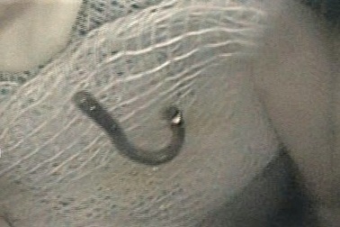 Bé trai 5 tuổi nuốt móc dây chuyền bạc đeo tay phải nhập viện cấp cứu