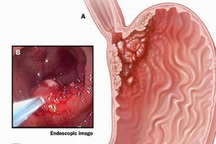 Nhận diện dấu hiệu căn bệnh ung thư đứng hàng thứ 4 tại Việt Nam