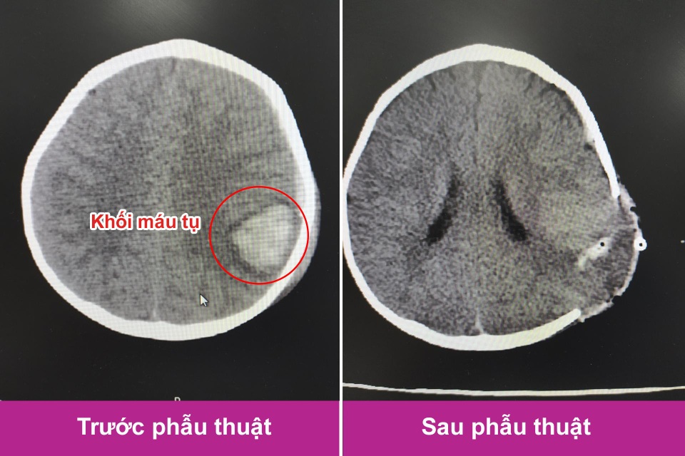 Trượt chân ngã cầu thang, bé trai 11 tháng tuổi bị kéo đâm trúng đầu - 1 Trượt chân ngã cầu thang, bé trai 11 tháng tuổi bị kéo đâm trúng đầu - 1