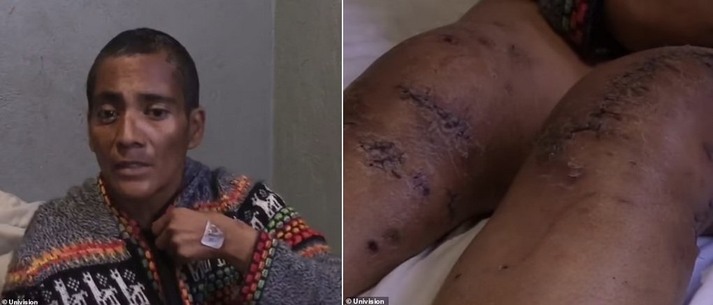 Bà Lidia Hernández và những vết thương do sư tử gây ra (Ảnh: Univision). Bà Lidia Hernández và những vết thương do sư tử gây ra (Ảnh: Univision).