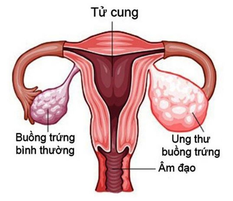 Liệu pháp tiêu chuẩn mới trong điều trị ung thư buồng trứng tái phát - 1 Liệu pháp tiêu chuẩn mới trong điều trị ung thư buồng trứng tái phát - 1