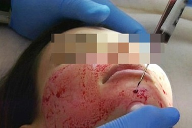 Rủ nhau làm đẹp bằng... máu