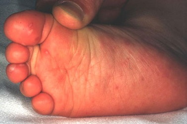 Thử nghiệm vắc-xin tay chân miệng