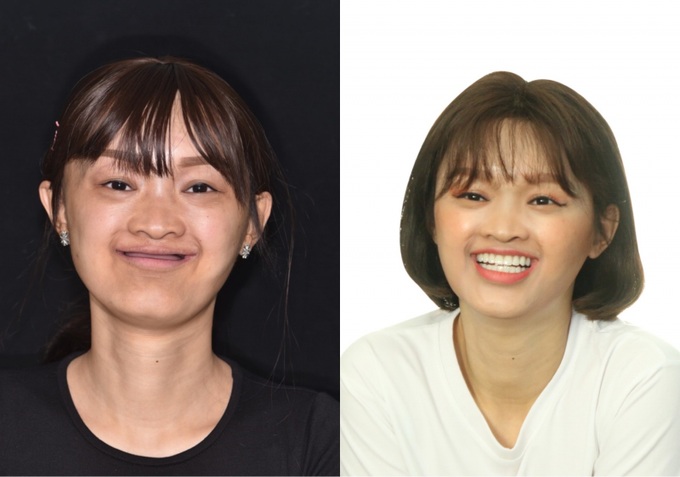Nụ cười thay đổi số phận của cô gái 27 năm không răng | Báo Dân trí
