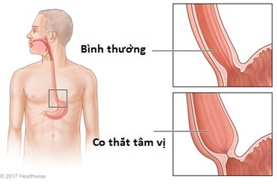 Những điều bạn cần biết để không lo lắng về ung thư thực quản - 4 Những điều bạn cần biết để không lo lắng về ung thư thực quản - 4