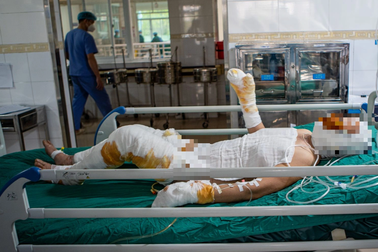 Tự chế pháo theo video mạng nhiều học sinh "mất Tết", nguy kịch vì bỏng