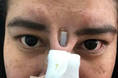 Kinh hoàng silicon nâng mũi chồi ra giữa 2 mắt