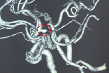 Đau đầu, mất ngủ coi chừng bệnh lý nguy hiểm