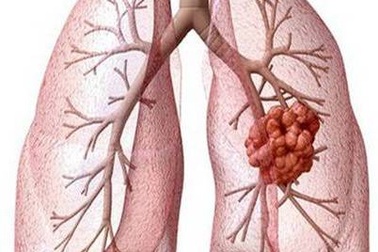 Liệu pháp nhắm trúng đích trong điều trị ung thư phổi