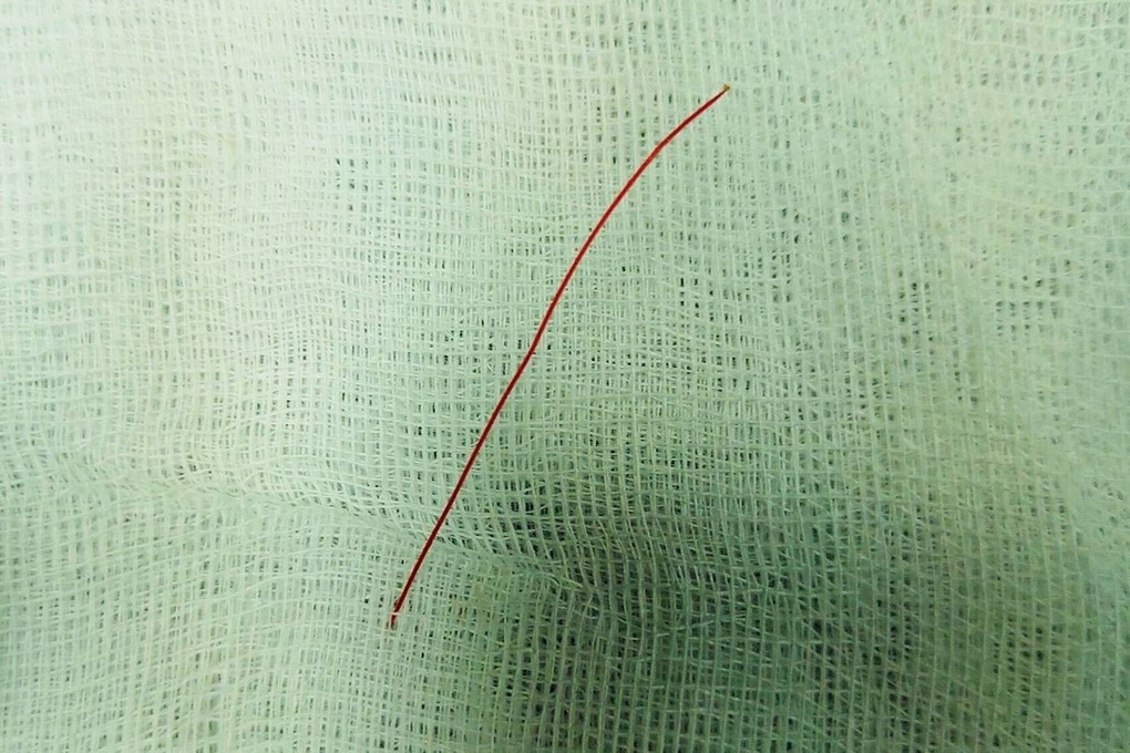 Sợi cước đâm thủng ruột non cháu bé 7 tuổi - 1 Sợi cước đâm thủng ruột non cháu bé 7 tuổi - 1