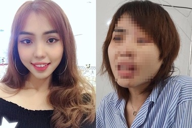 Nỗi đau ám ảnh của cô gái xinh đẹp bị chồng chưa cưới tạt axit