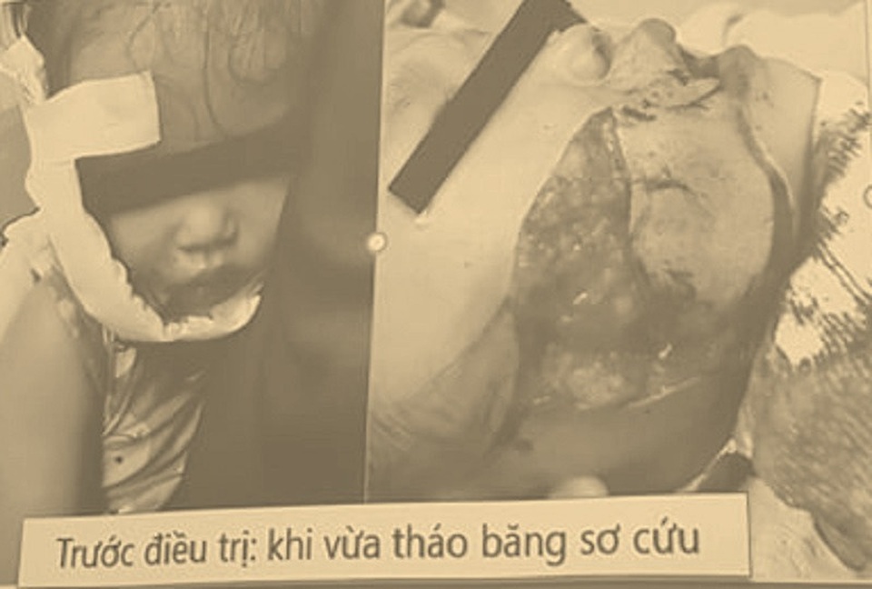 Đang ăn xúc xích, bé trai bị chó tấn công cướp đồ ăn, cắn vùng đầu mặt - 2 Đang ăn xúc xích, bé trai bị chó tấn công cướp đồ ăn, cắn vùng đầu mặt - 2