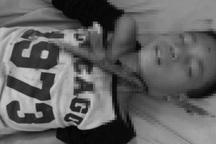 Thiếu niên 12 tuổi bị cành cây dài 0,4m đâm xuyên vào cổ