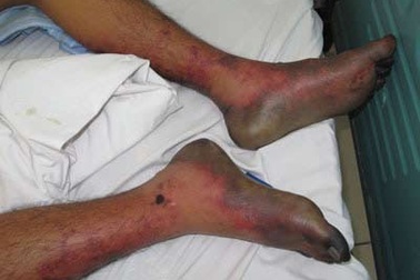 Suy đa phủ tạng vì mê tiết canh