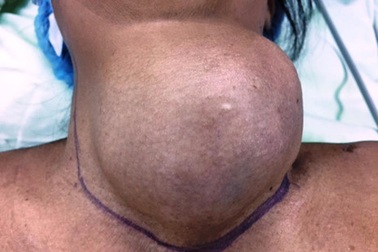 Mang khối u nặng 1,2 kg ở cổ suốt 18 năm