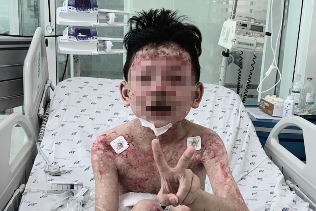 Bé trai 8 tuổi lở loét khắp người, nhiễm trùng nặng nề sau khi ăn cua - 1 Bé trai 8 tuổi lở loét khắp người, nhiễm trùng nặng nề sau khi ăn cua - 1