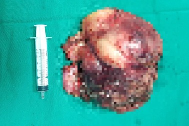 Hà Nội: Khối u to bằng quả bưởi vì "ngại Covid-19" không đi khám