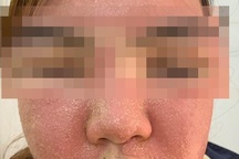 Đắp mặt nạ trắng da, mặt cô gái trẻ sưng vù, nổi mụn