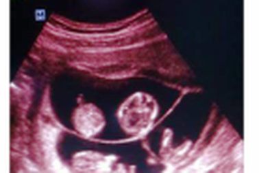 Một phụ nữ mang thai 4 tự nhiên hiếm gặp