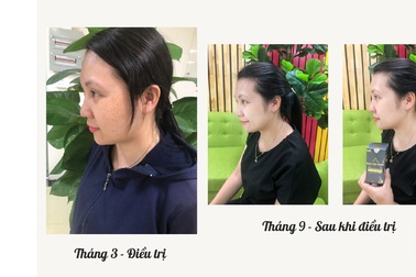 Bạch Mộc Nhiên – Giải pháp hỗ trợ điều trị nám, tàn nhang an toàn hiệu quả