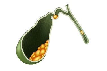 Viêm túi mật cấp hay mạn tính, chủ quan đều nguy hiểm