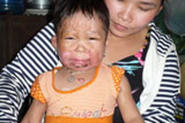 Lời cảm ơn của gia đình cháu bé có làn da bỏng lửa