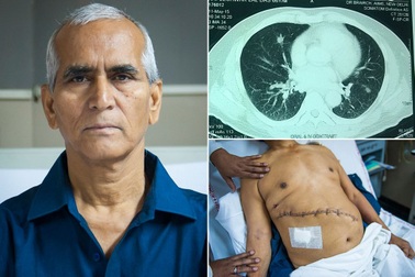 Đến viện khám ho, phát hiện u thận to bằng quả dưa hấu