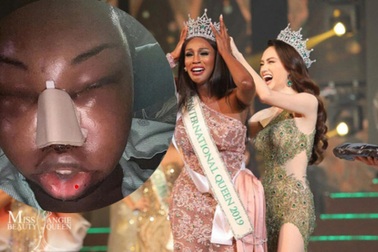 Hoa hậu chuyển giới quốc tế gây sốc khi công khai ảnh "đập mặt, xây lại"