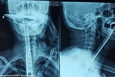 Suýt chết vì nuốt thìa để “thông” cổ họng