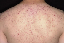 Cô gái sốc phản vệ, dị ứng thuốc tê khi điều trị mụn lưng ở spa