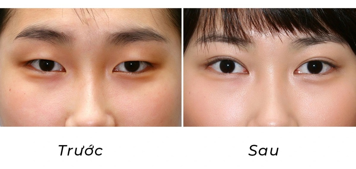 Bác sĩ thẩm mỹ mắt nổi tiếng Hàn Quốc sắp trở lại Việt Nam - 3 Bác sĩ thẩm mỹ mắt nổi tiếng Hàn Quốc sắp trở lại Việt Nam - 3