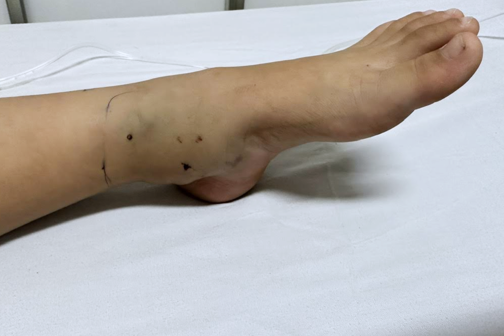Cấp cứu bé gái 4 tuổi bị rắn lục đuôi đỏ cắn khi đi bộ qua bãi cỏ - 1 Cấp cứu bé gái 4 tuổi bị rắn lục đuôi đỏ cắn khi đi bộ qua bãi cỏ - 1