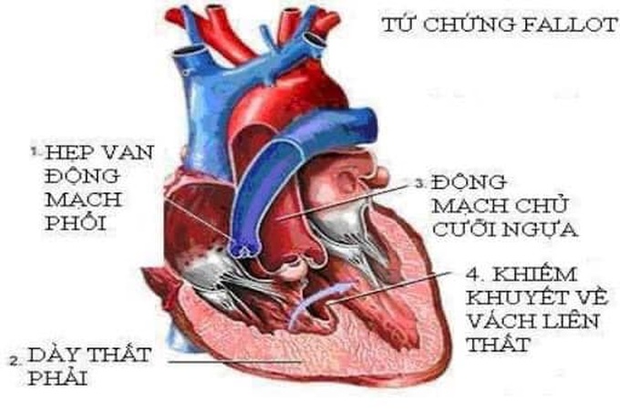Tứ chứng Fallot là bệnh lý tim bẩm sinh đặc trưng bởi 4 tổn thương về mặt cấu trúc trong tim.