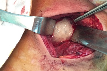 Cứu sống 1 bệnh nhân bị áp xe trung thất do thủng thực quản