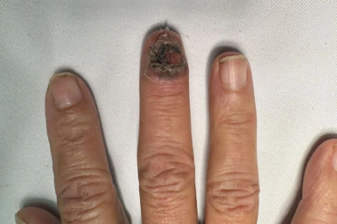 Từ móng tay đen, phát hiện ung thư da