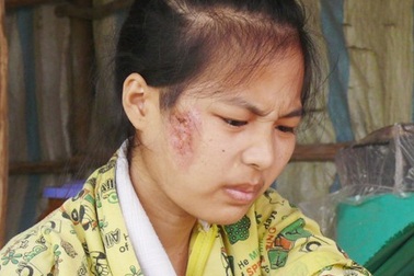 Chứng bệnh quái ác của cô gái "nghèo rớt mồng tơi"
