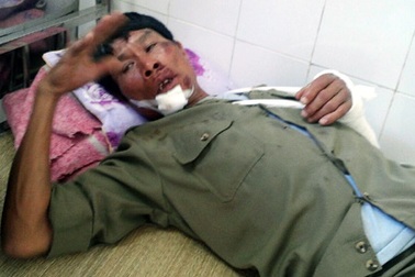 Hà Nội: Đi bắt kẻ trộm chó, một bảo vệ bị đâm gãy tay