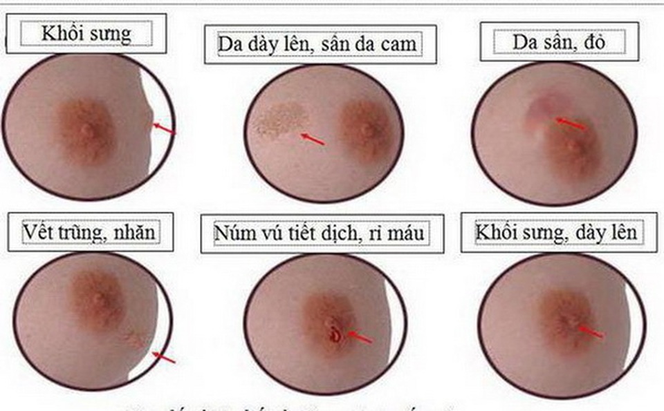 Cách tự kiểm tra phát hiện ung thư vú - 1 Cách tự kiểm tra phát hiện ung thư vú - 1